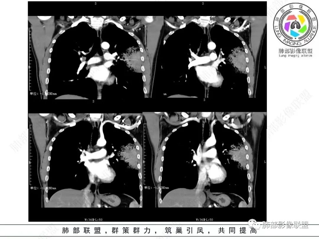 影像PPT - 【病例】 最经典的肺炎型肺癌1例CT-33 影像PPT - 【病例】 最经典的肺炎型肺癌1例CT-33