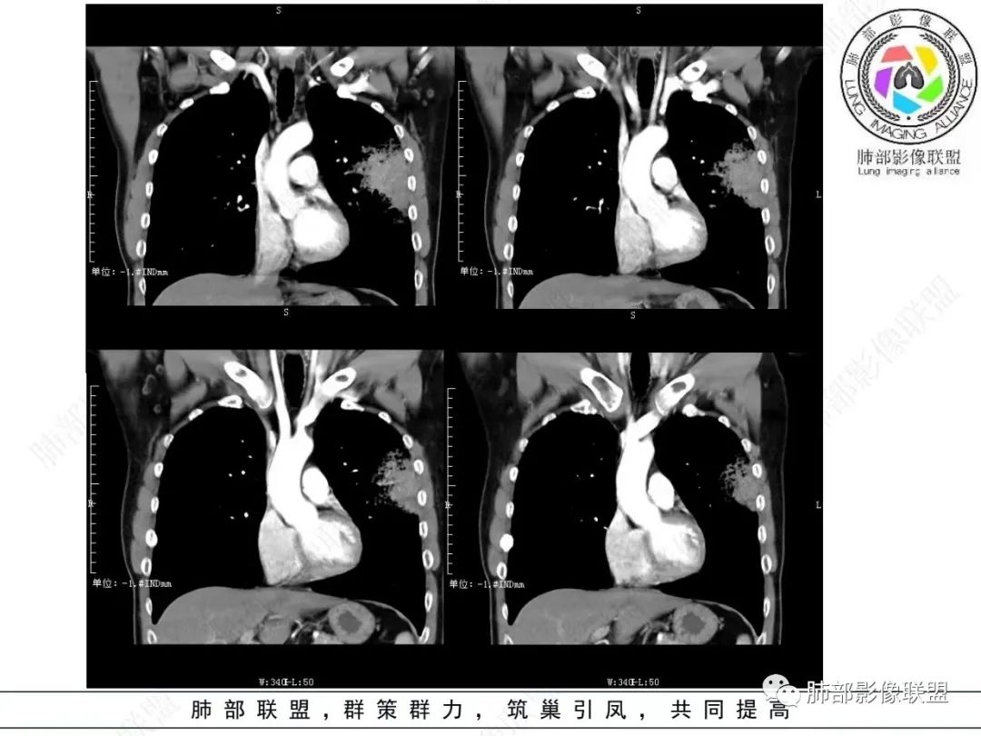 影像PPT - 【病例】 最经典的肺炎型肺癌1例CT-34 影像PPT - 【病例】 最经典的肺炎型肺癌1例CT-34