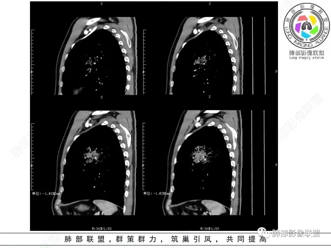影像PPT - 【病例】 最经典的肺炎型肺癌1例CT-35 影像PPT - 【病例】 最经典的肺炎型肺癌1例CT-35