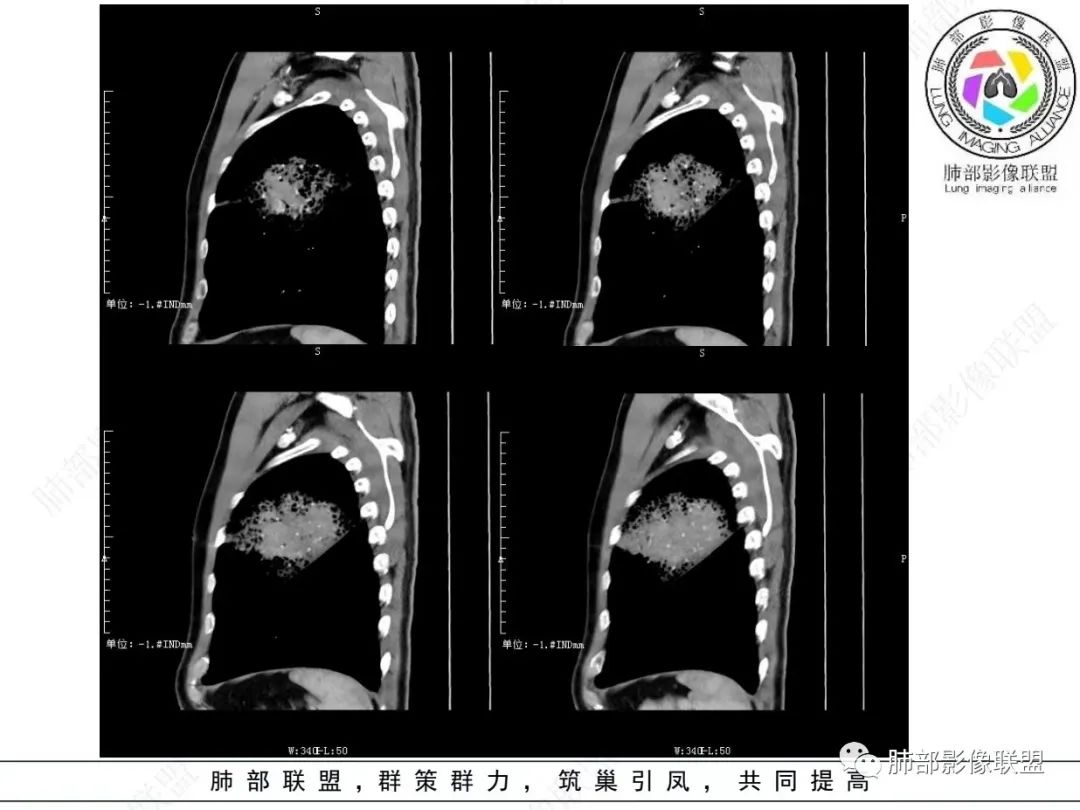 影像PPT - 【病例】 最经典的肺炎型肺癌1例CT-36 影像PPT - 【病例】 最经典的肺炎型肺癌1例CT-36