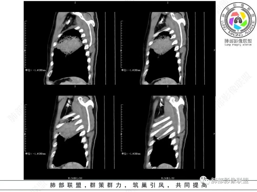 影像PPT - 【病例】 最经典的肺炎型肺癌1例CT-37 影像PPT - 【病例】 最经典的肺炎型肺癌1例CT-37
