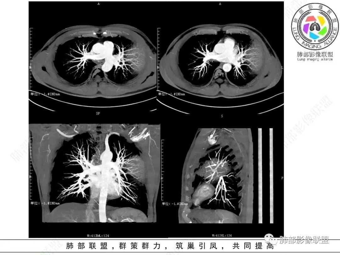 影像PPT - 【病例】 最经典的肺炎型肺癌1例CT-38 影像PPT - 【病例】 最经典的肺炎型肺癌1例CT-38