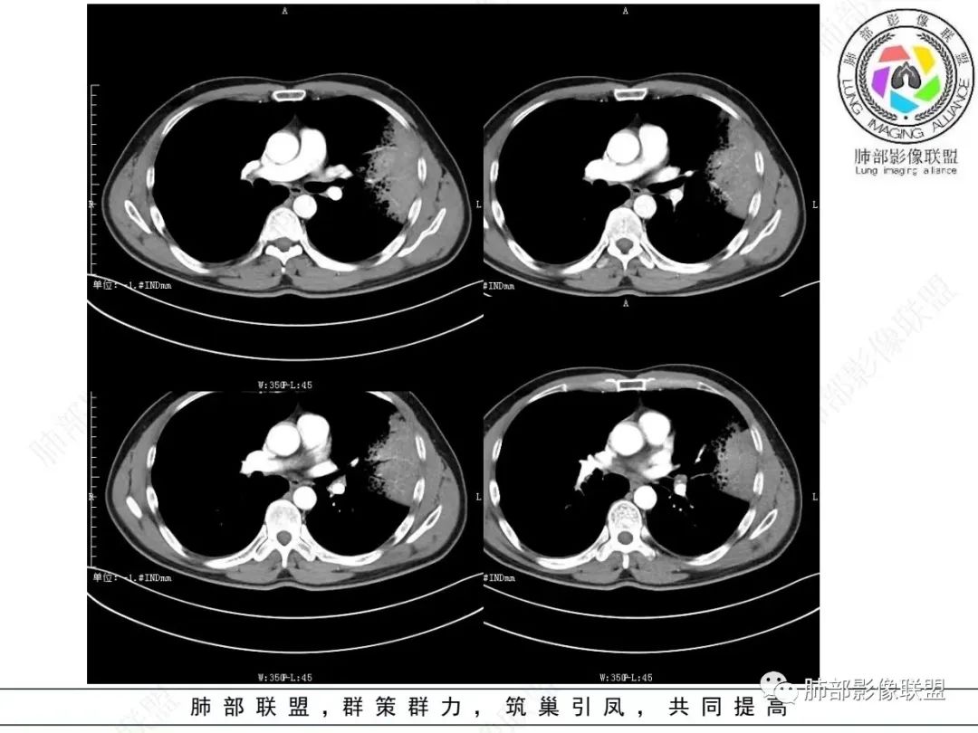 影像PPT - 【病例】 最经典的肺炎型肺癌1例CT-29 影像PPT - 【病例】 最经典的肺炎型肺癌1例CT-29