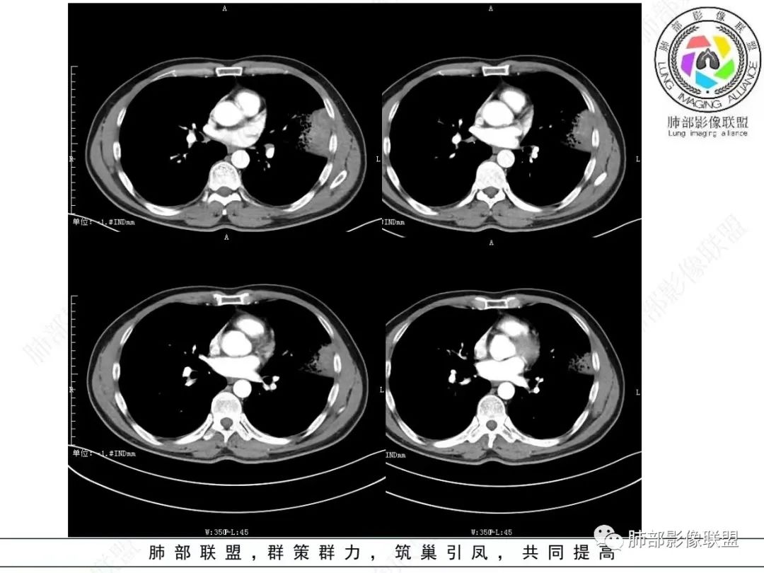 影像PPT - 【病例】 最经典的肺炎型肺癌1例CT-30 影像PPT - 【病例】 最经典的肺炎型肺癌1例CT-30