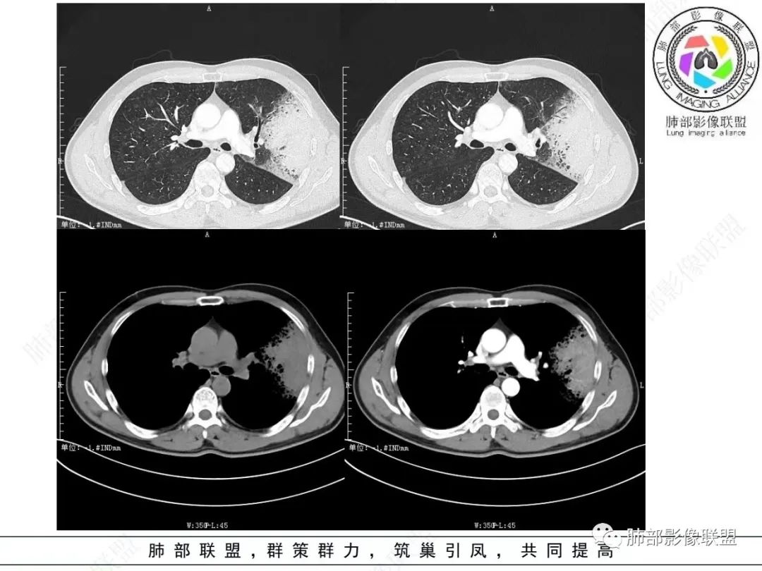 影像PPT - 【病例】 最经典的肺炎型肺癌1例CT-39 影像PPT - 【病例】 最经典的肺炎型肺癌1例CT-39