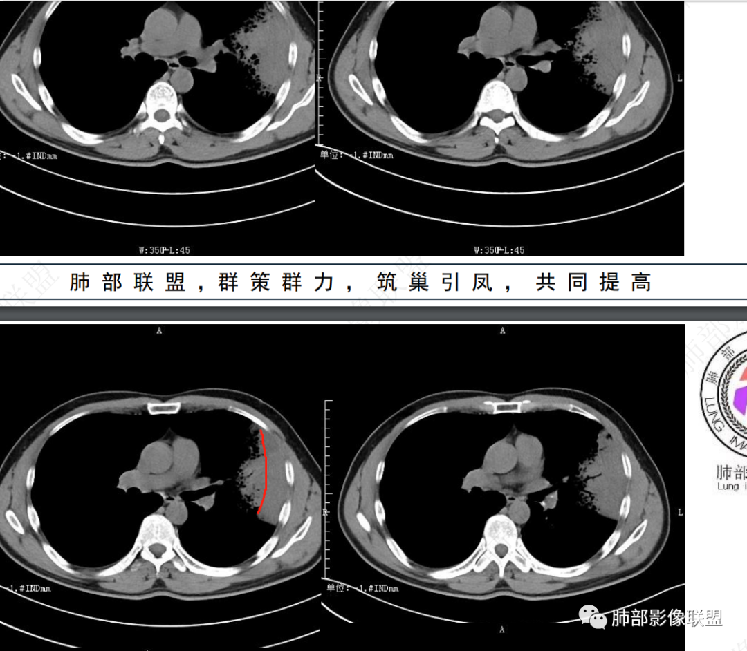 影像PPT - 【病例】 最经典的肺炎型肺癌1例CT-52 影像PPT - 【病例】 最经典的肺炎型肺癌1例CT-52