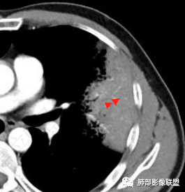 影像PPT - 【病例】 最经典的肺炎型肺癌1例CT-56 影像PPT - 【病例】 最经典的肺炎型肺癌1例CT-56