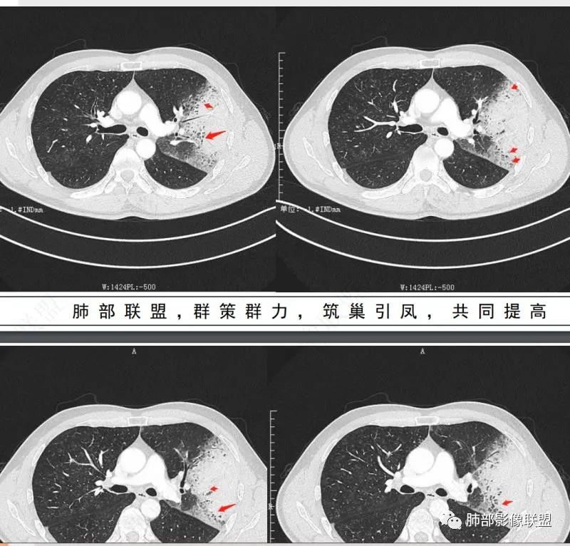 影像PPT - 【病例】 最经典的肺炎型肺癌1例CT-57 影像PPT - 【病例】 最经典的肺炎型肺癌1例CT-57