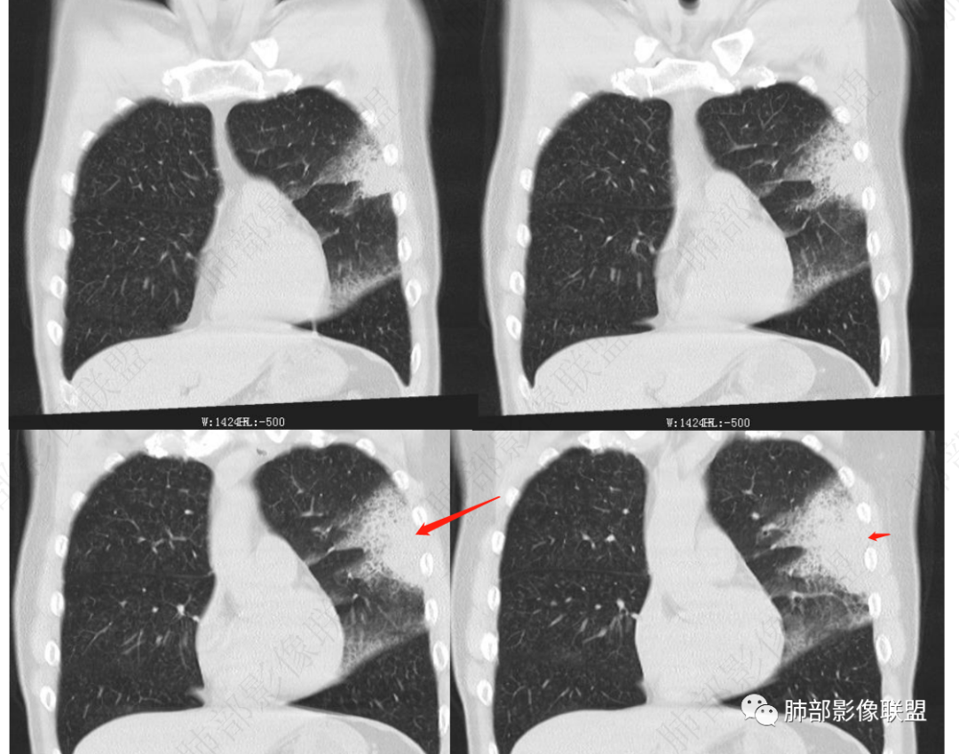 影像PPT - 【病例】 最经典的肺炎型肺癌1例CT-51 影像PPT - 【病例】 最经典的肺炎型肺癌1例CT-51