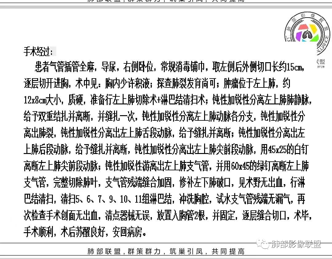影像PPT - 【病例】 最经典的肺炎型肺癌1例CT-63 影像PPT - 【病例】 最经典的肺炎型肺癌1例CT-63