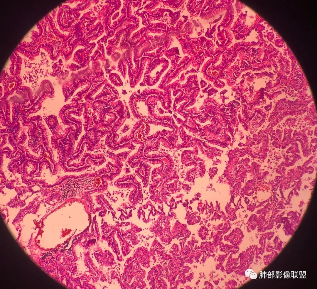 影像PPT - 【病例】 最经典的肺炎型肺癌1例CT-66 影像PPT - 【病例】 最经典的肺炎型肺癌1例CT-66