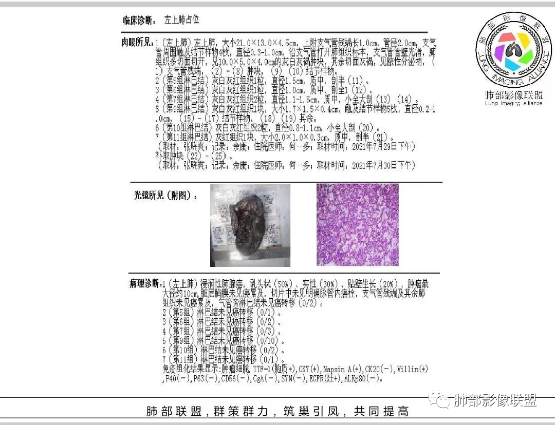 影像PPT - 【病例】 最经典的肺炎型肺癌1例CT-64 影像PPT - 【病例】 最经典的肺炎型肺癌1例CT-64