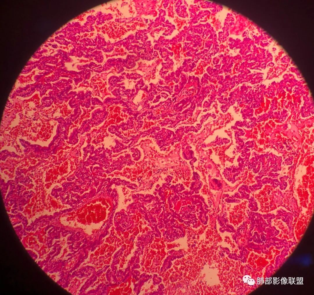 影像PPT - 【病例】 最经典的肺炎型肺癌1例CT-72 影像PPT - 【病例】 最经典的肺炎型肺癌1例CT-72