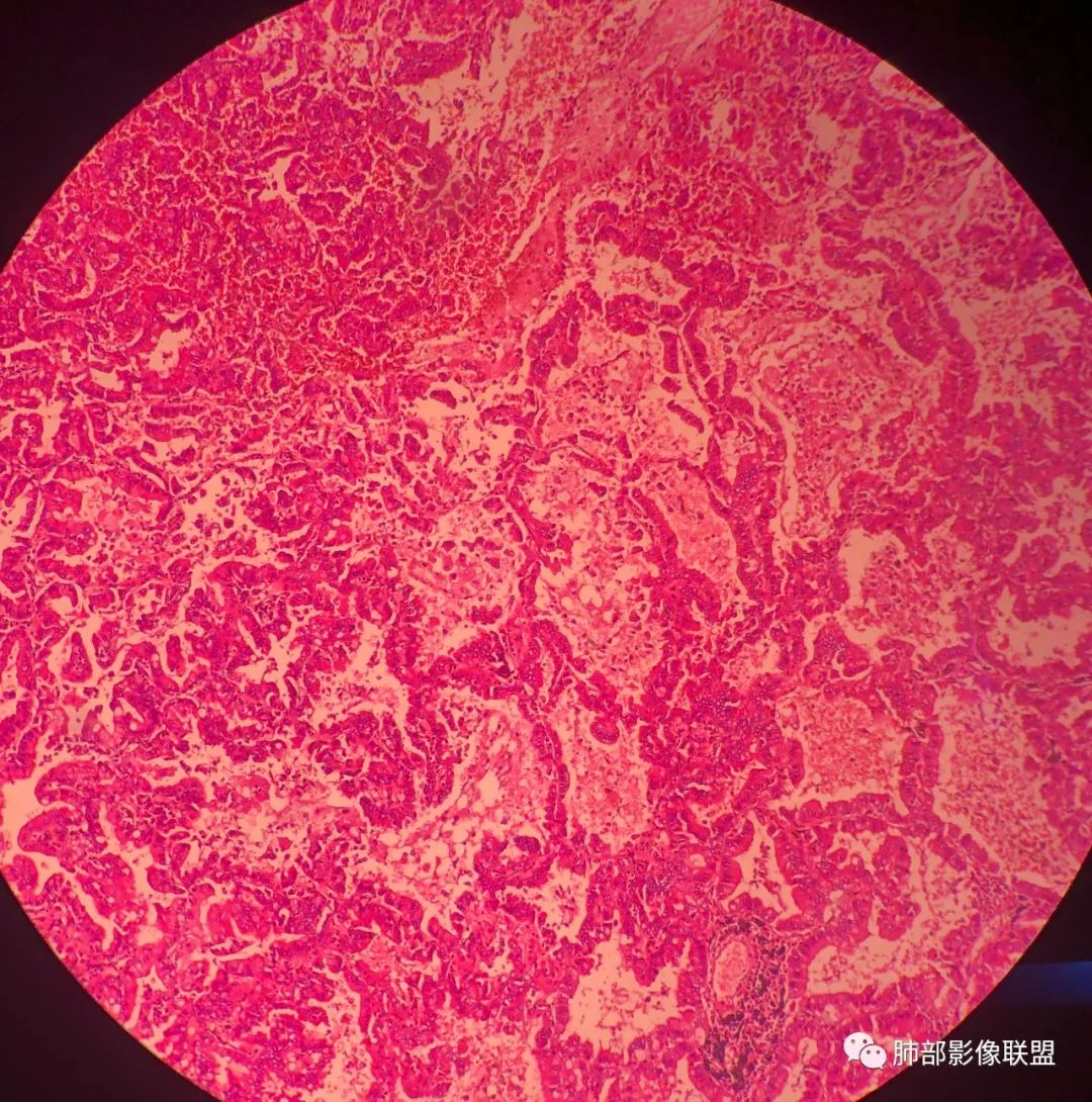 影像PPT - 【病例】 最经典的肺炎型肺癌1例CT-69 影像PPT - 【病例】 最经典的肺炎型肺癌1例CT-69