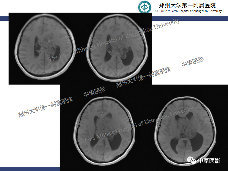 影像PPT - 【病例】中枢神经细胞瘤1例MR-3