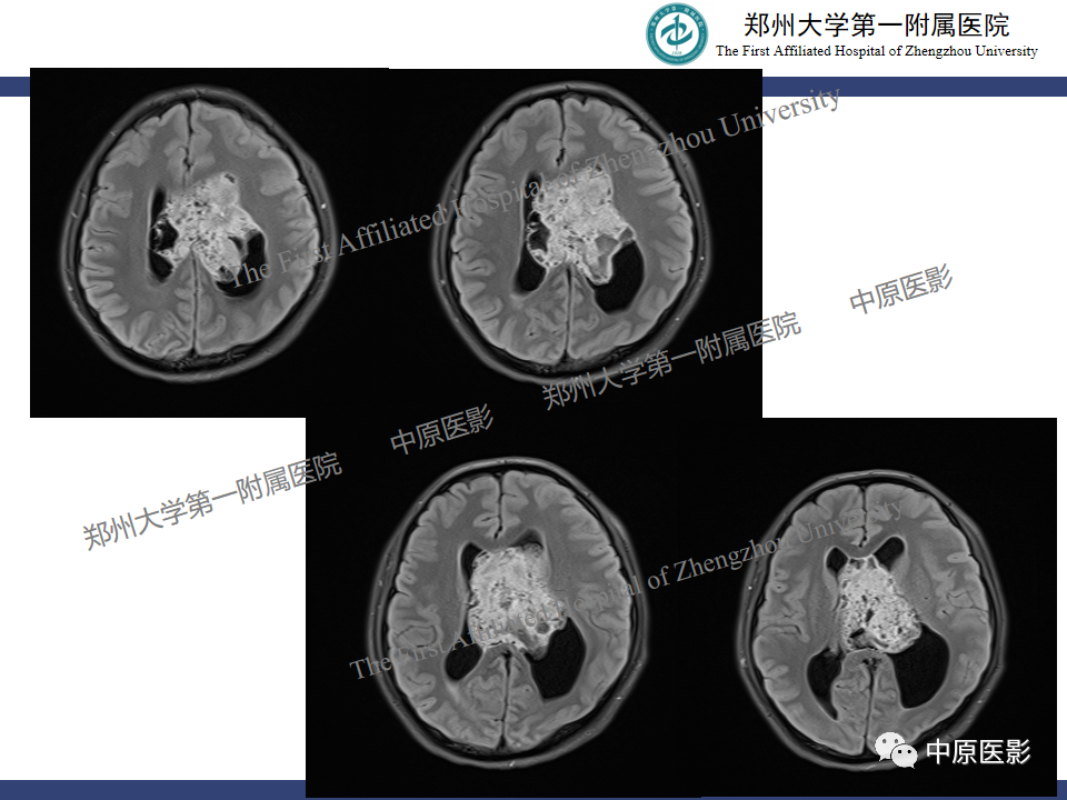 影像PPT - 【病例】中枢神经细胞瘤1例MR-5