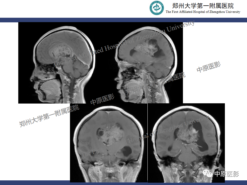 影像PPT - 【病例】中枢神经细胞瘤1例MR-8