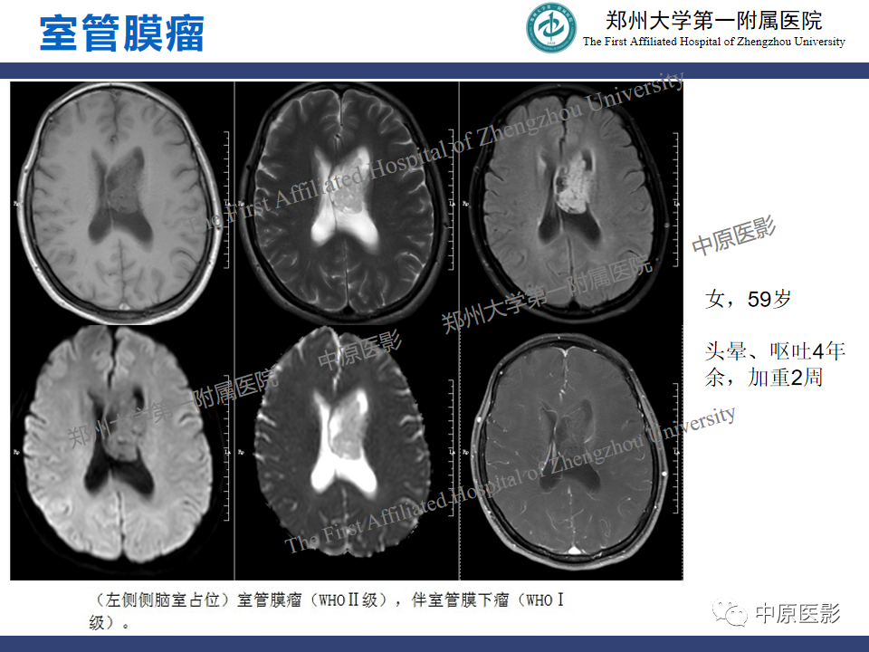 影像PPT - 【病例】中枢神经细胞瘤1例MR-16