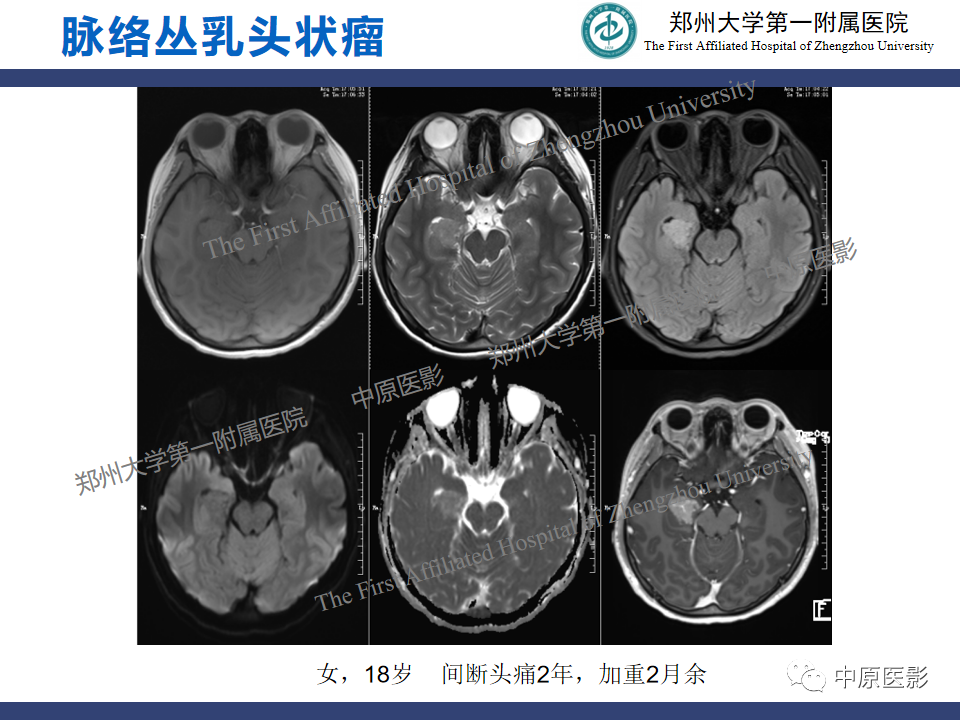 影像PPT - 【病例】中枢神经细胞瘤1例MR-18
