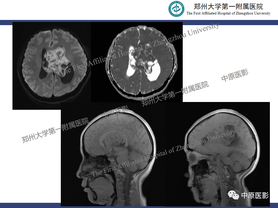影像PPT - 【病例】中枢神经细胞瘤1例MR-6