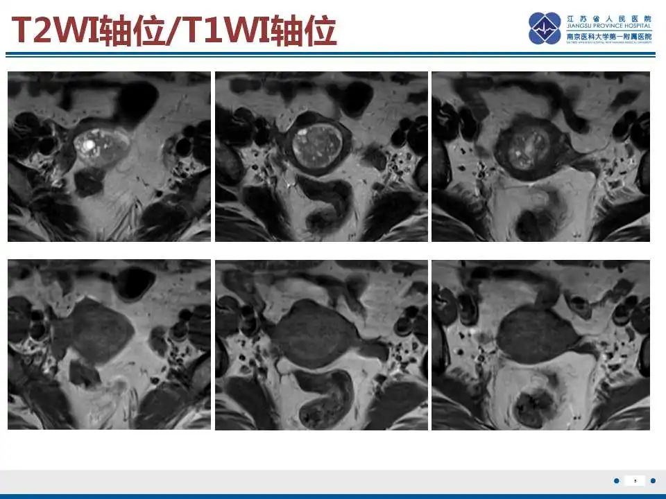 影像PPT - 【PPT】子宫腺肉瘤-6