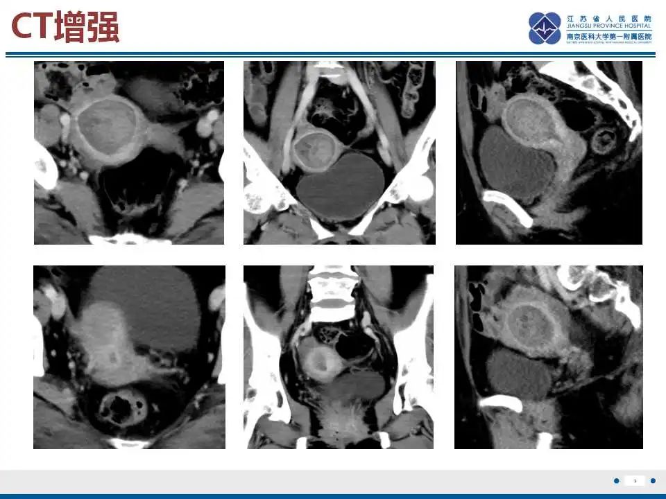 影像PPT - 【PPT】子宫腺肉瘤-4