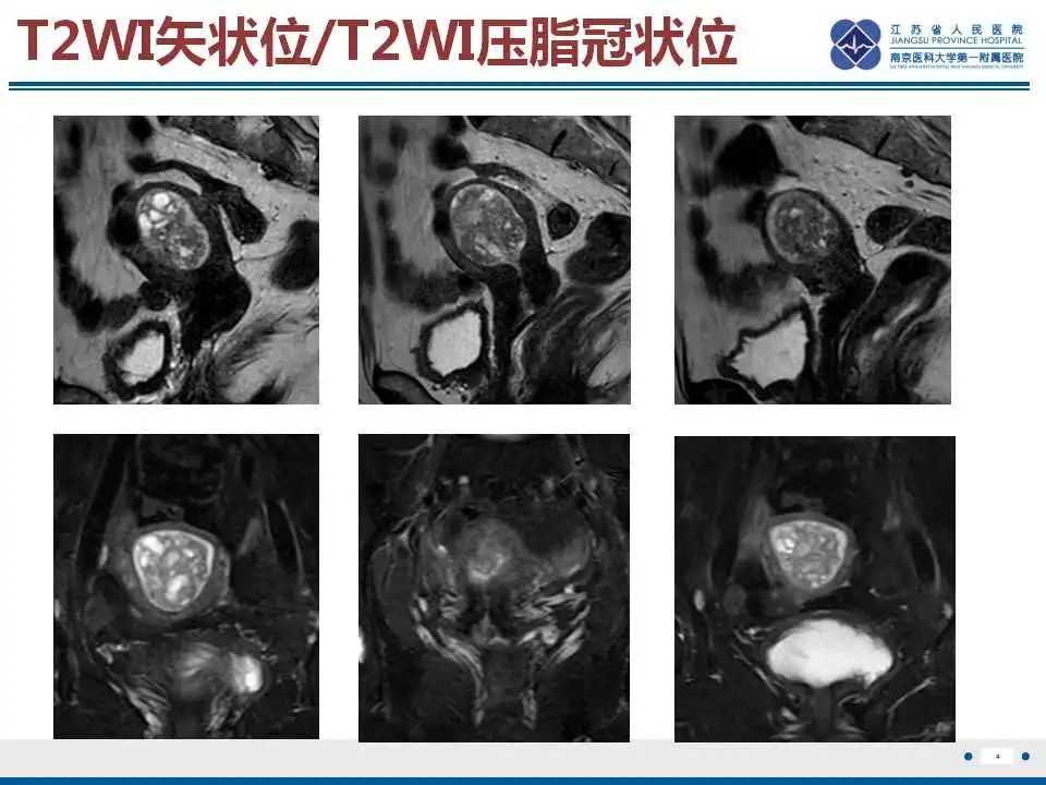 影像PPT - 【PPT】子宫腺肉瘤-5
