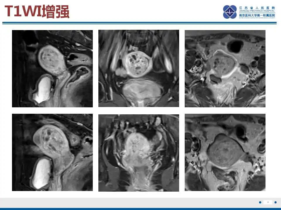 影像PPT - 【PPT】子宫腺肉瘤-8