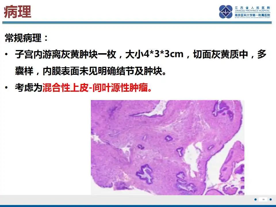影像PPT - 【PPT】子宫腺肉瘤-16