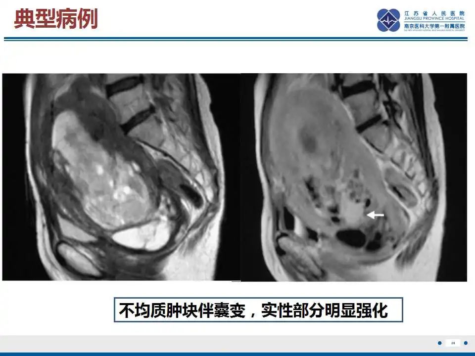 影像PPT - 【PPT】子宫腺肉瘤-27
