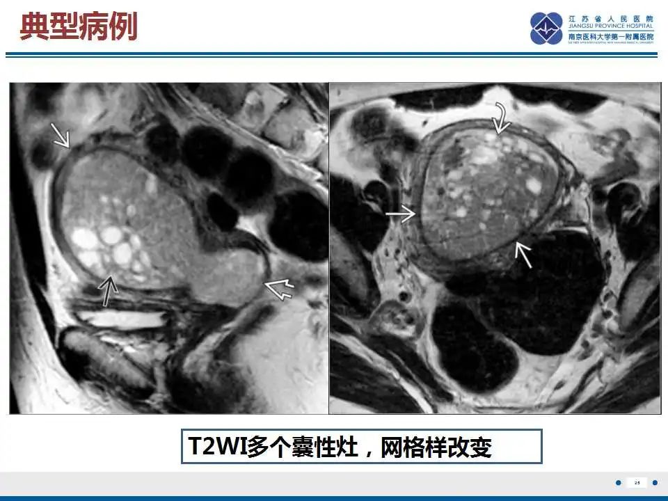 影像PPT - 【PPT】子宫腺肉瘤-26