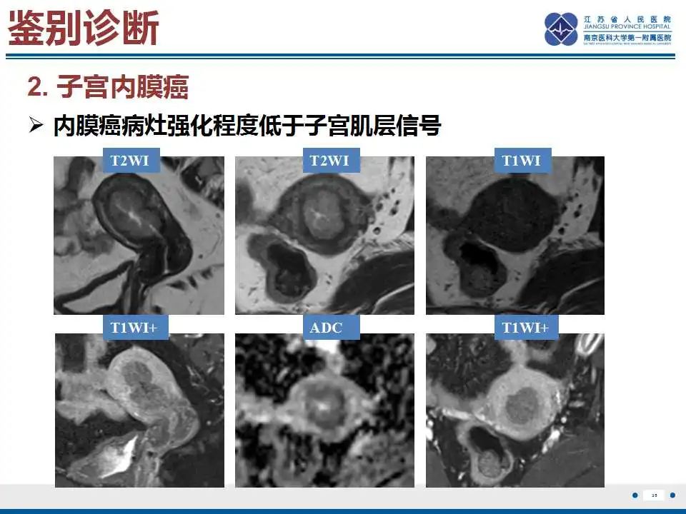 影像PPT - 【PPT】子宫腺肉瘤-36