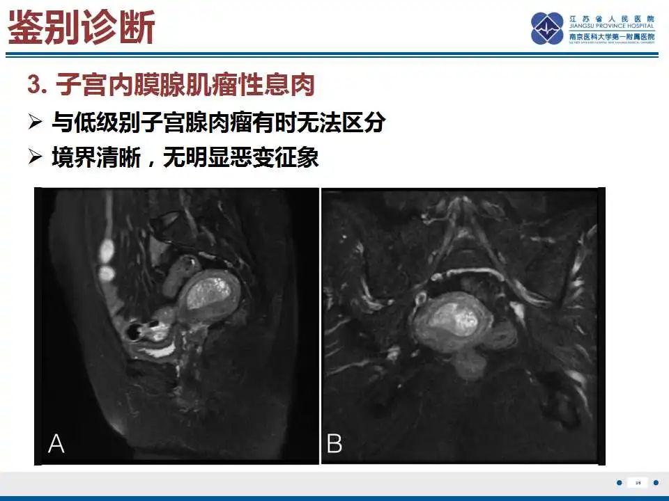 影像PPT - 【PPT】子宫腺肉瘤-37