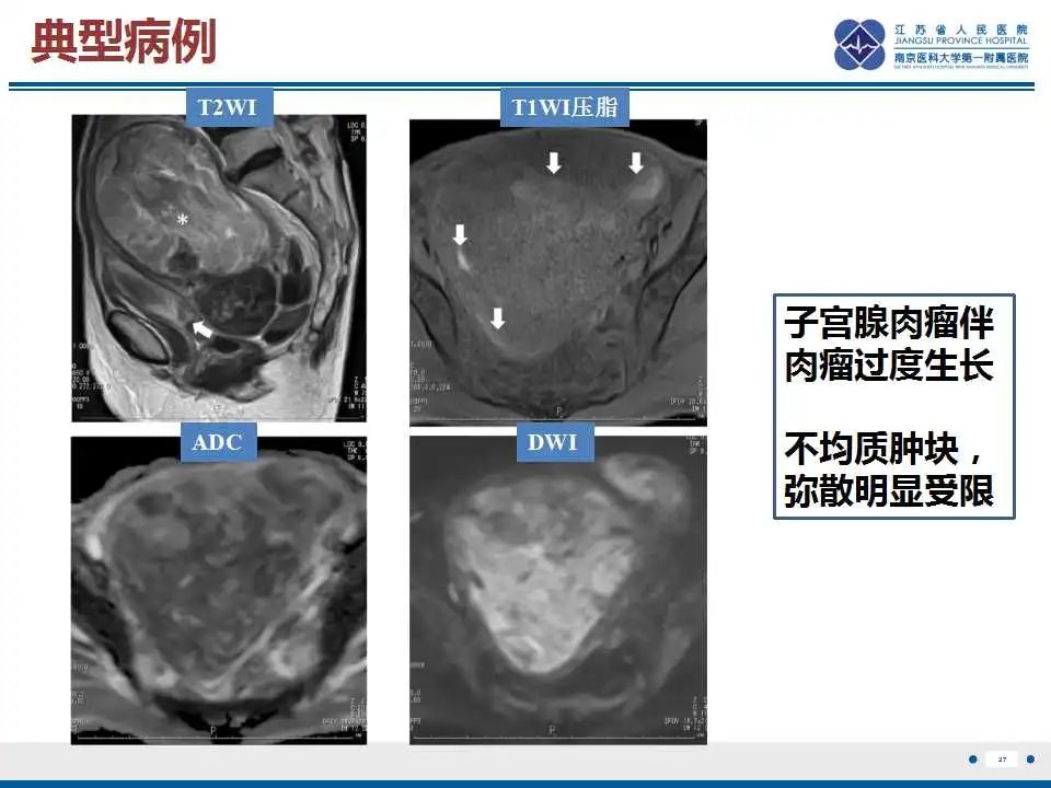 影像PPT - 【PPT】子宫腺肉瘤-28
