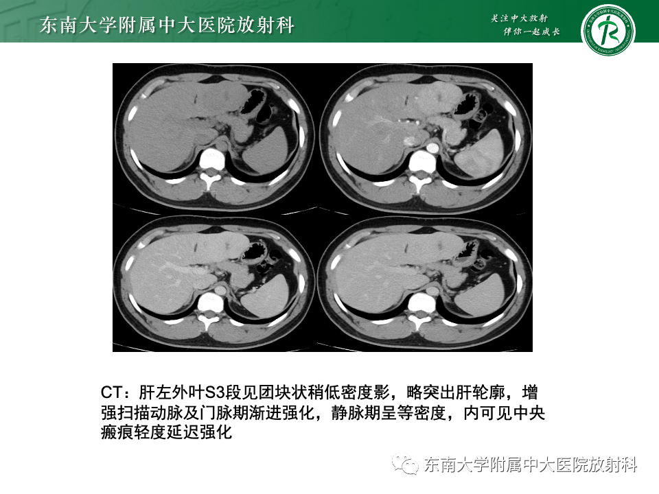 影像PPT - 【PPT】肝脏局灶性结节增生-4