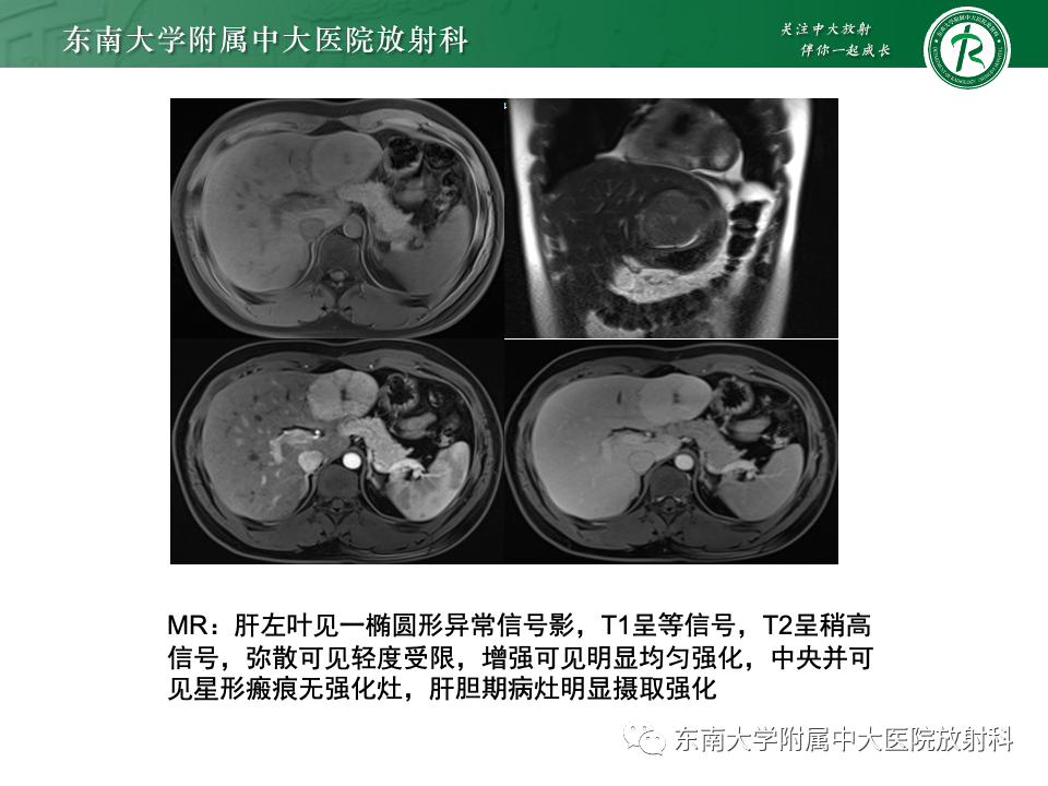 影像PPT - 【PPT】肝脏局灶性结节增生-5