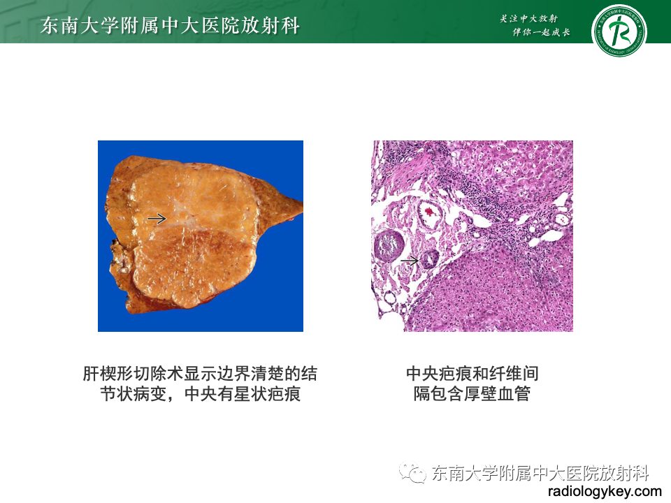 影像PPT - 【PPT】肝脏局灶性结节增生-10