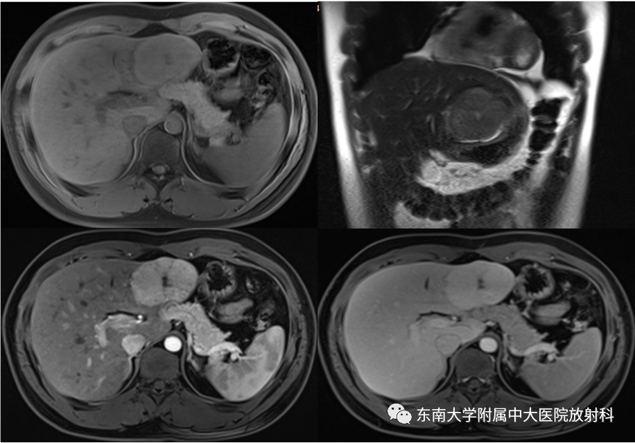 影像PPT - 【PPT】肝脏局灶性结节增生-2