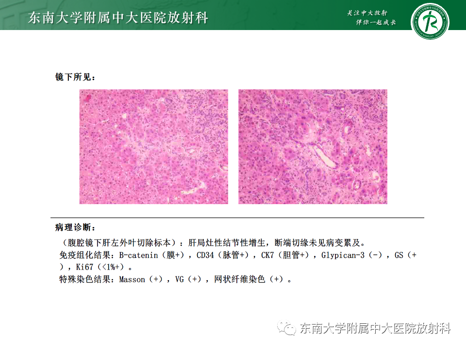 影像PPT - 【PPT】肝脏局灶性结节增生-6