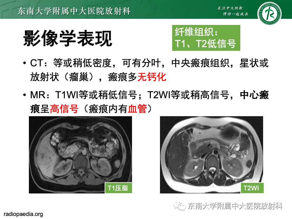 影像PPT - 【PPT】肝脏局灶性结节增生-12