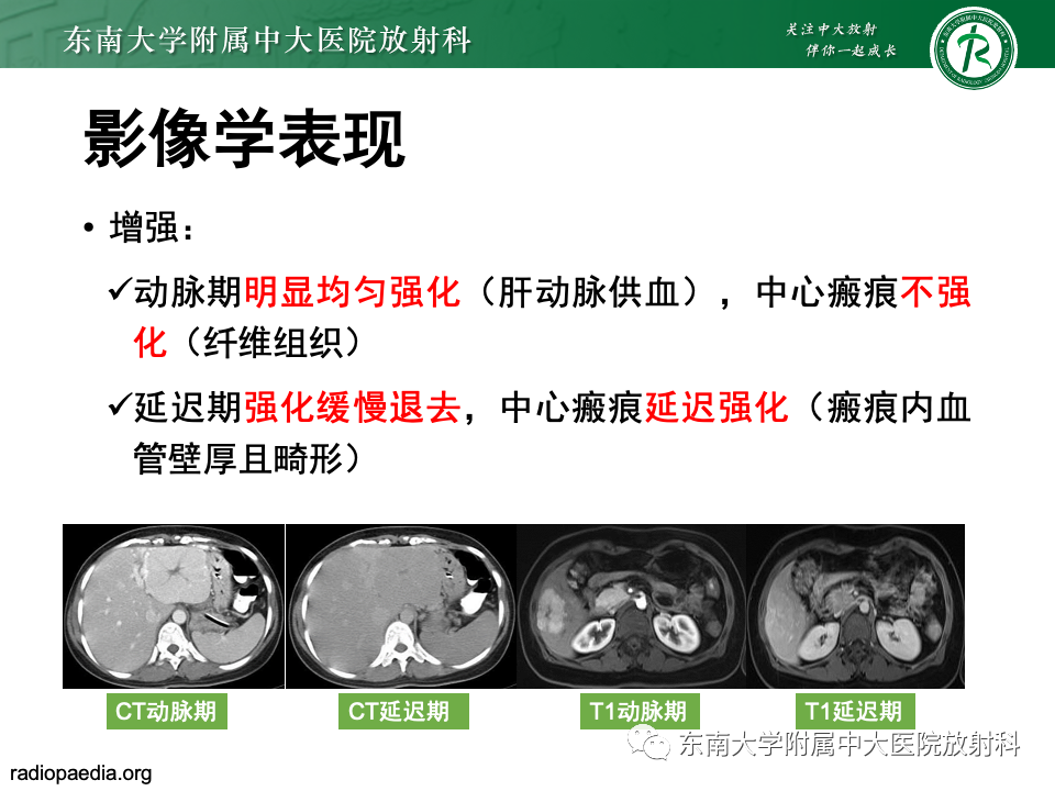 影像PPT - 【PPT】肝脏局灶性结节增生-13