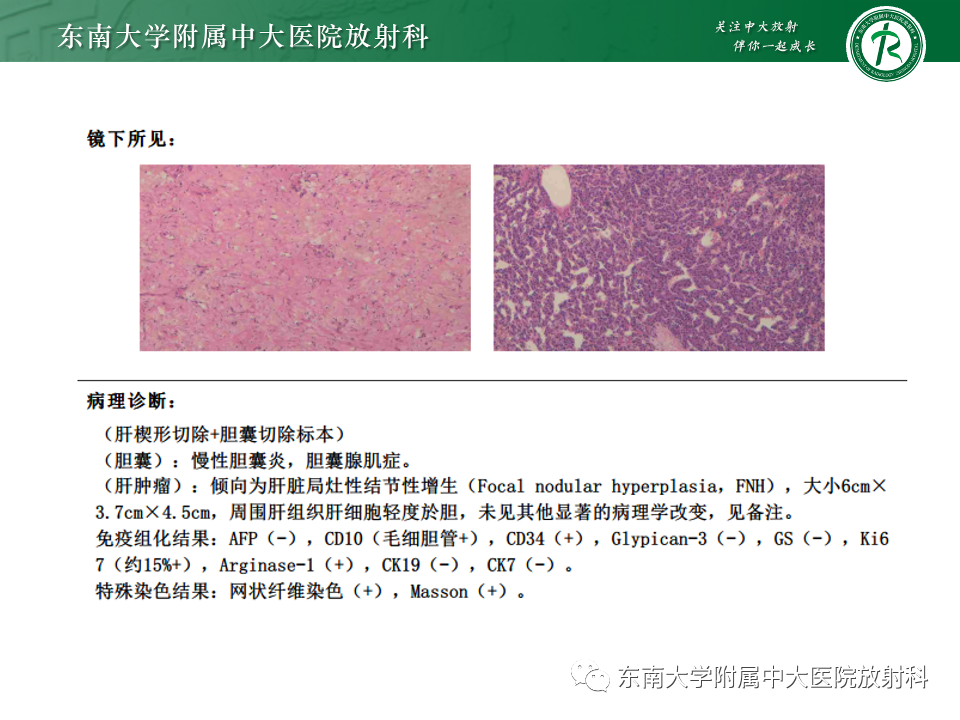 影像PPT - 【PPT】肝脏局灶性结节增生-17