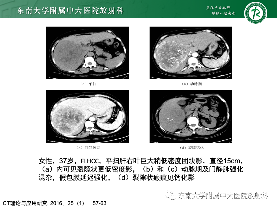 影像PPT - 【PPT】肝脏局灶性结节增生-20