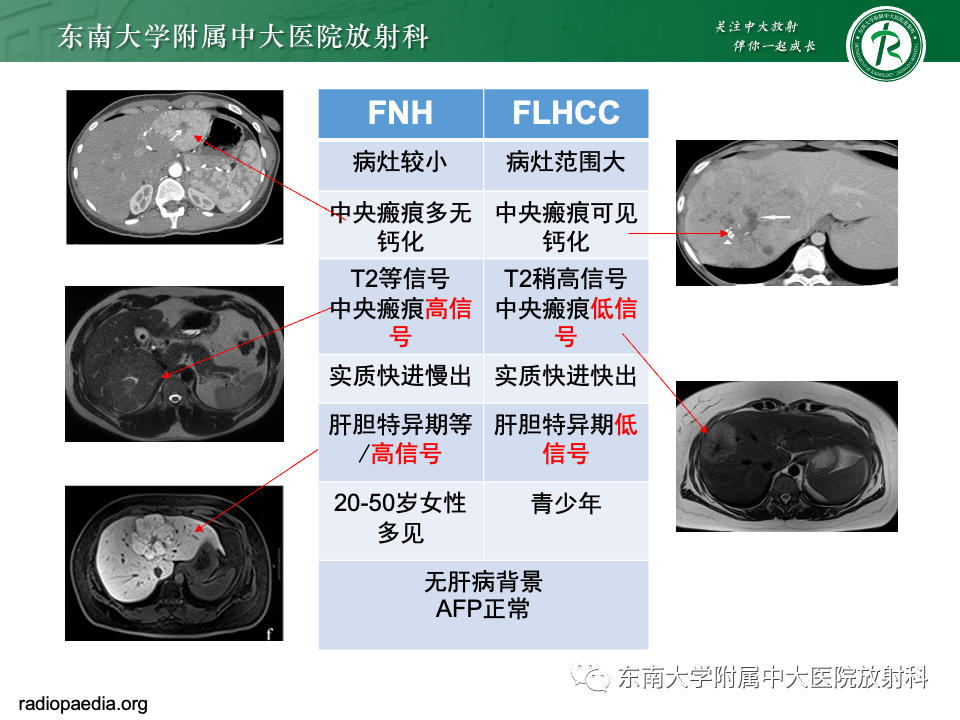 影像PPT - 【PPT】肝脏局灶性结节增生-22
