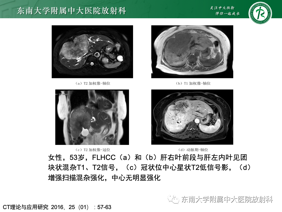 影像PPT - 【PPT】肝脏局灶性结节增生-21