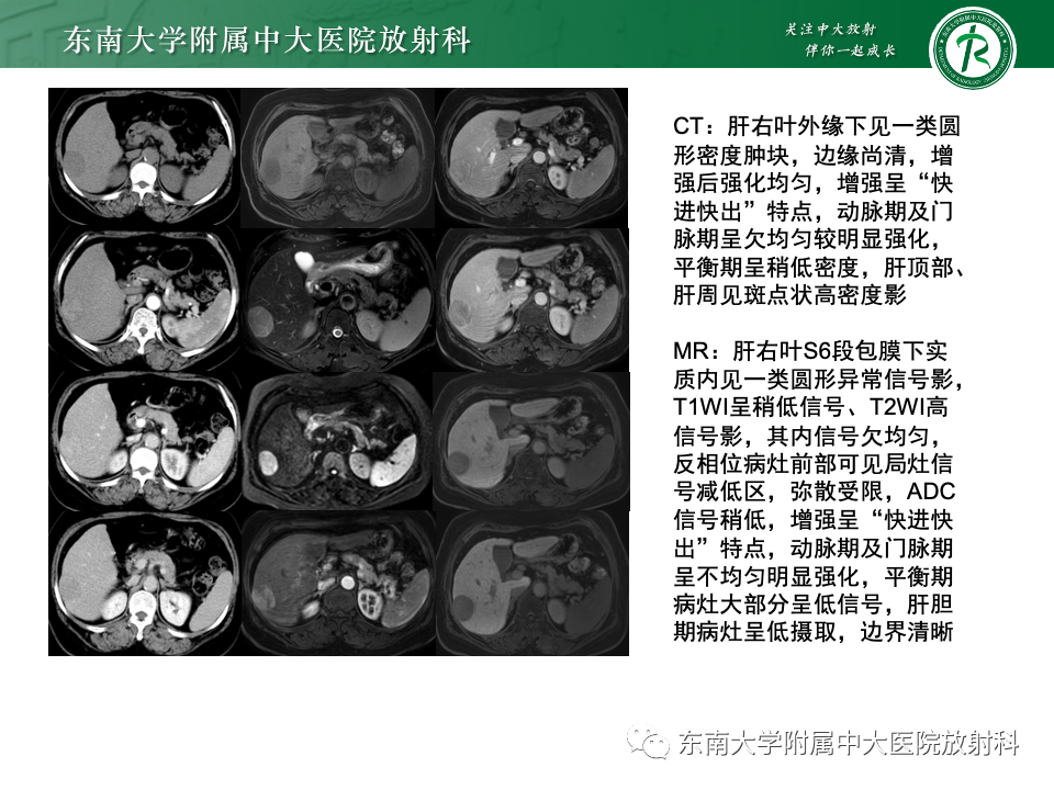 影像PPT - 【PPT】肝脏局灶性结节增生-24