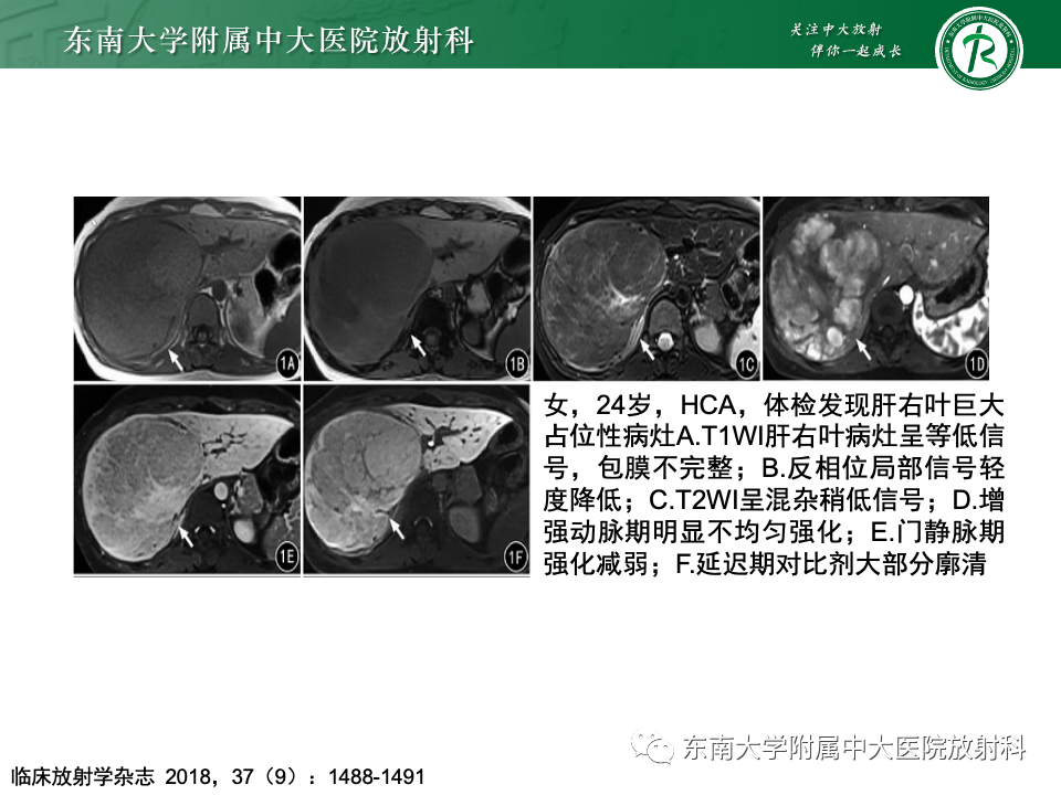 影像PPT - 【PPT】肝脏局灶性结节增生-29