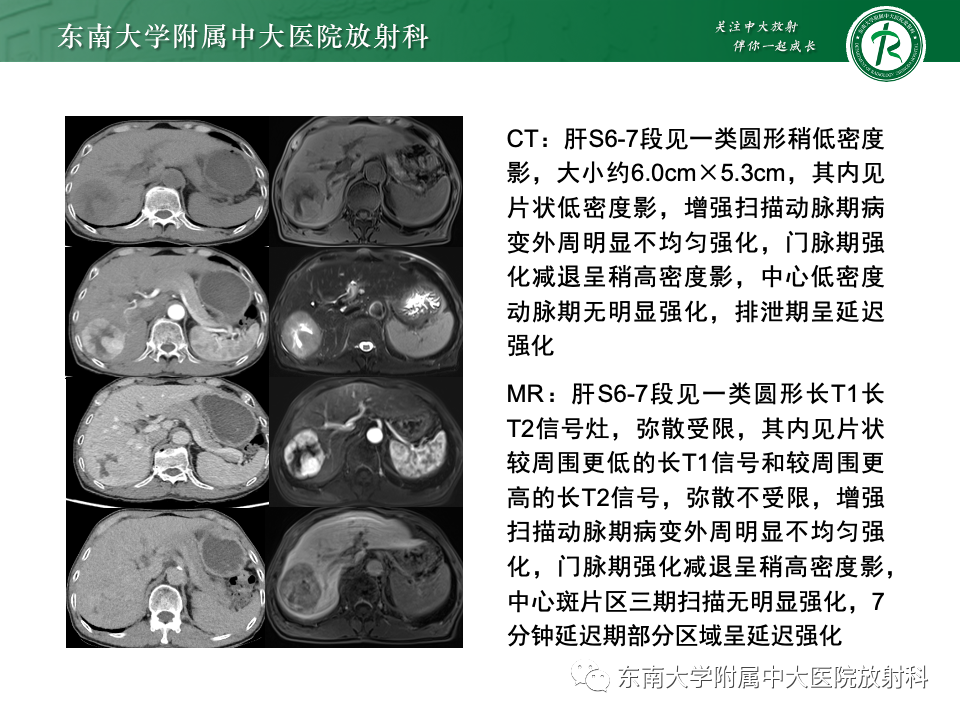 影像PPT - 【PPT】肝脏局灶性结节增生-16