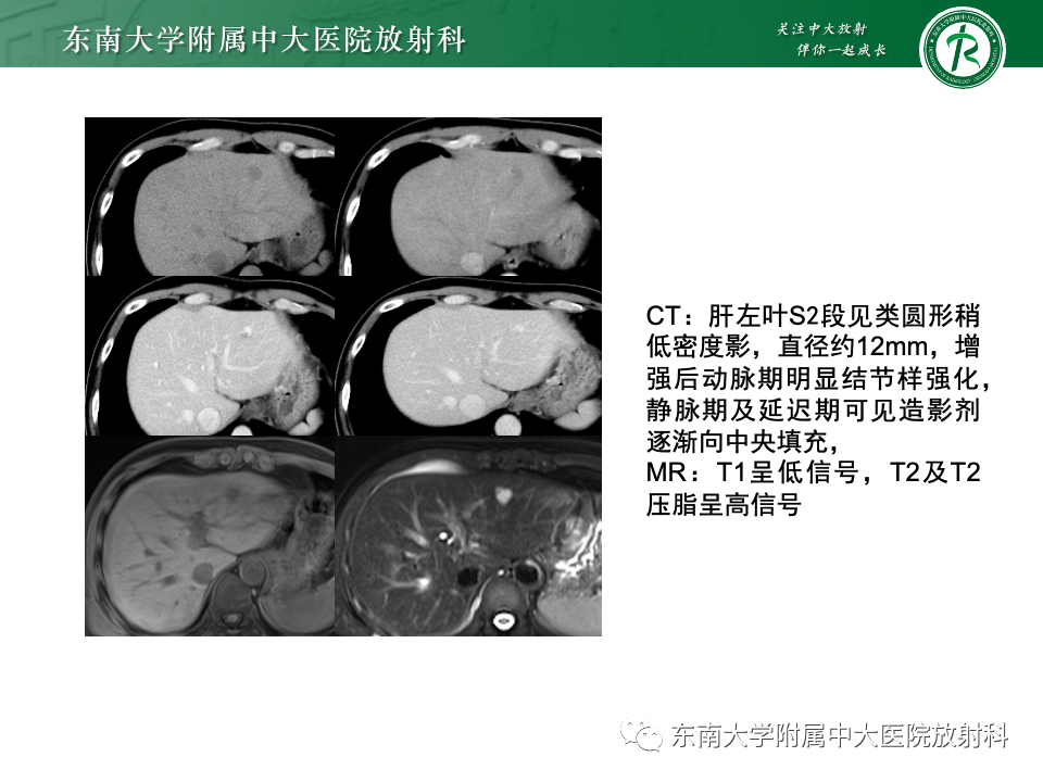影像PPT - 【PPT】肝脏局灶性结节增生-31
