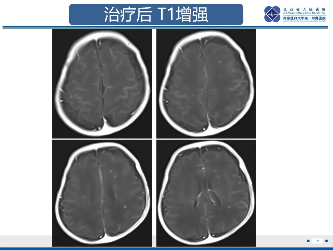 影像PPT - 【PPT】Baby\'s breath(满天星)​—新生儿侵袭性念珠菌病-16
